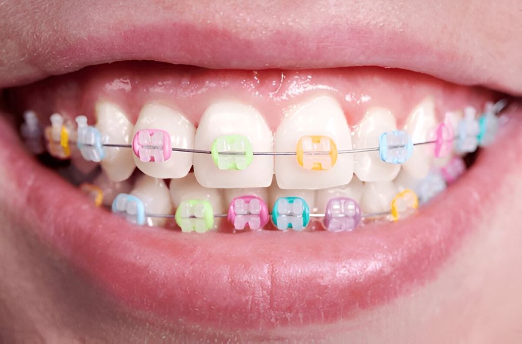 color my braces