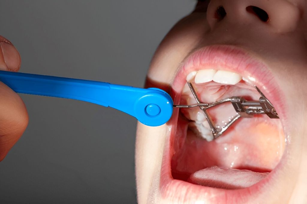 palatal expander in woodridge il