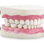 Is It Too Late for My Child? Best Age for a Herbst Appliance