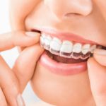 How Invisalign Fits Into Your Daily Lifestyle