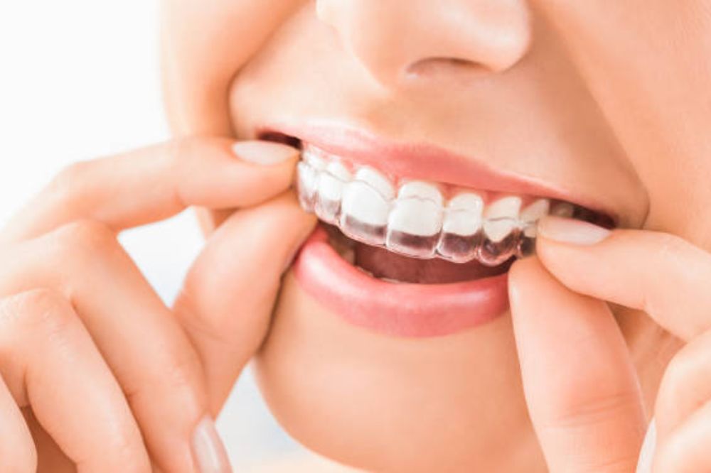 How Invisalign Fits Into Your Daily Lifestyle